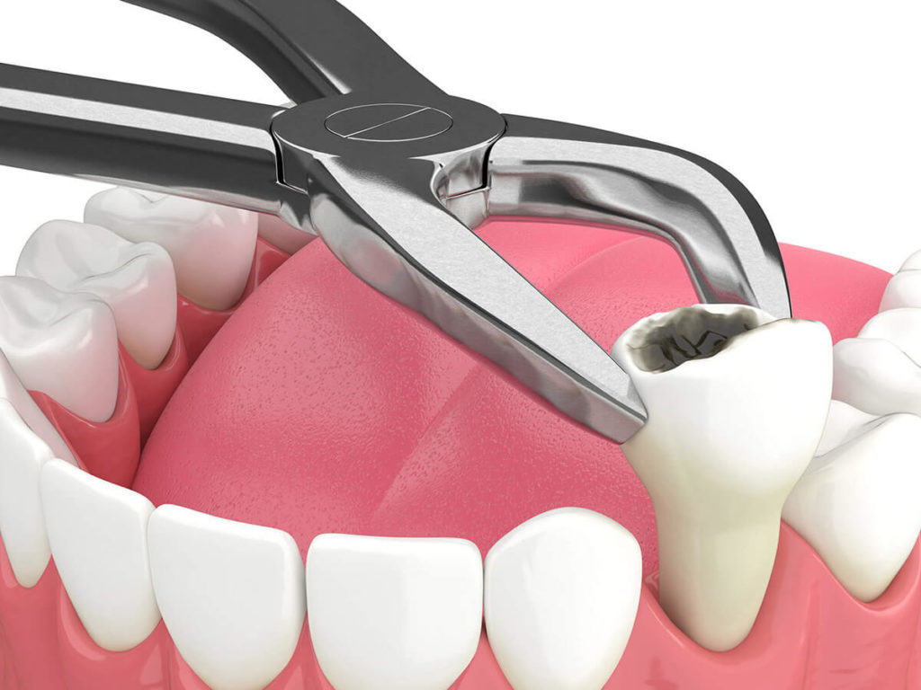 3D illustration of a tooth extraction process showing an upper premolar being removed with dental forceps, set against a white and pink background to depict oral surgery.