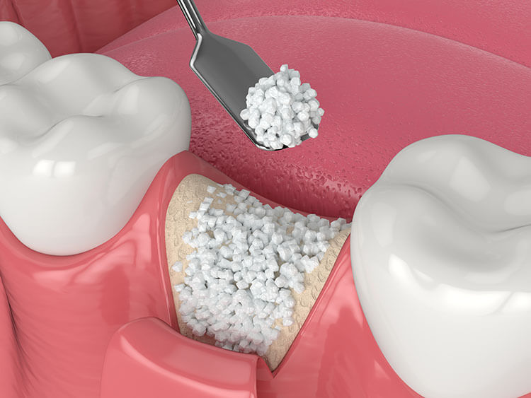 Bone Graft