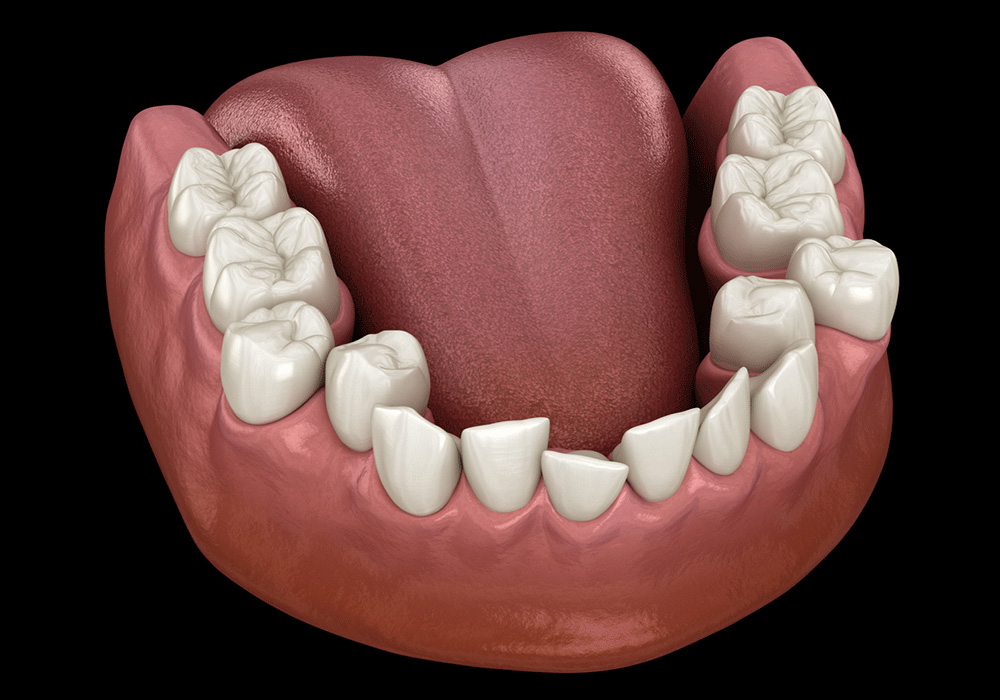 a 3D anatomical view of an open mouth, showcasing the upper and lower teeth along with the tongue.